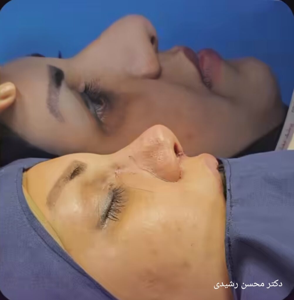 جراحی زیبایی بینی با دکتر محسن رشیدی؛ بهتربن جراح بینی در چابهار