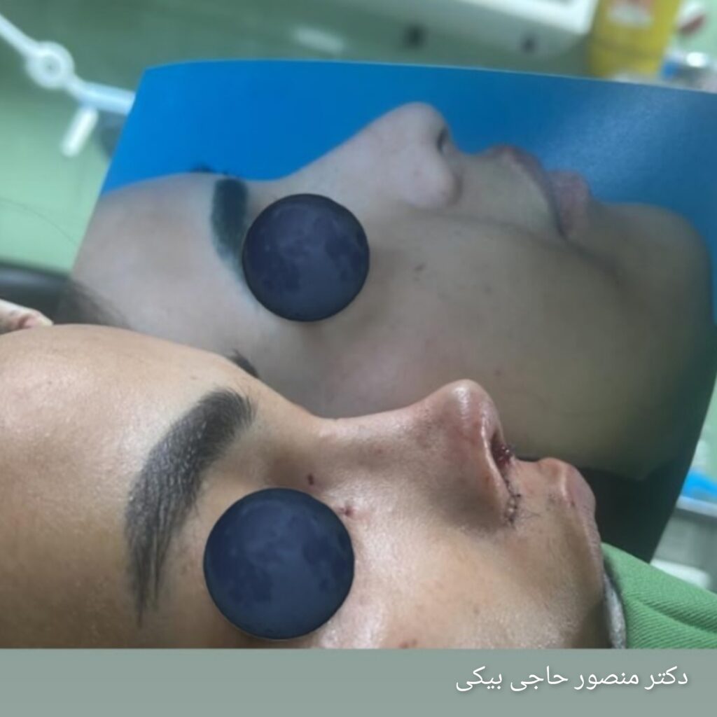 عمل زیبایی بینی دکتر منصور حاجی بیکی؛ بهتربن جراح بینی در چابهار