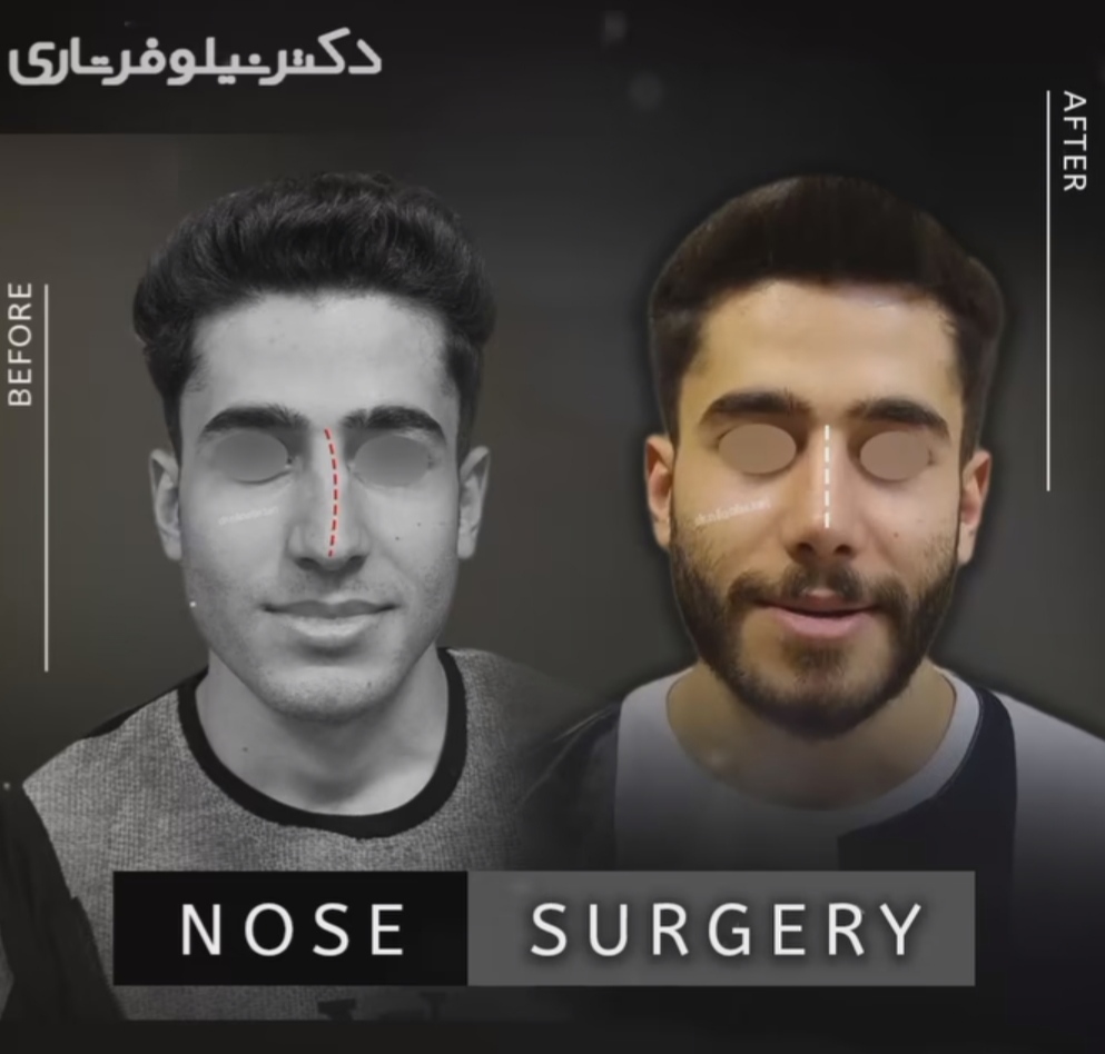 جراحی زیبایی بینی دکتر نیلوفر تاری؛ بهتربن جراح بینی در چابهار