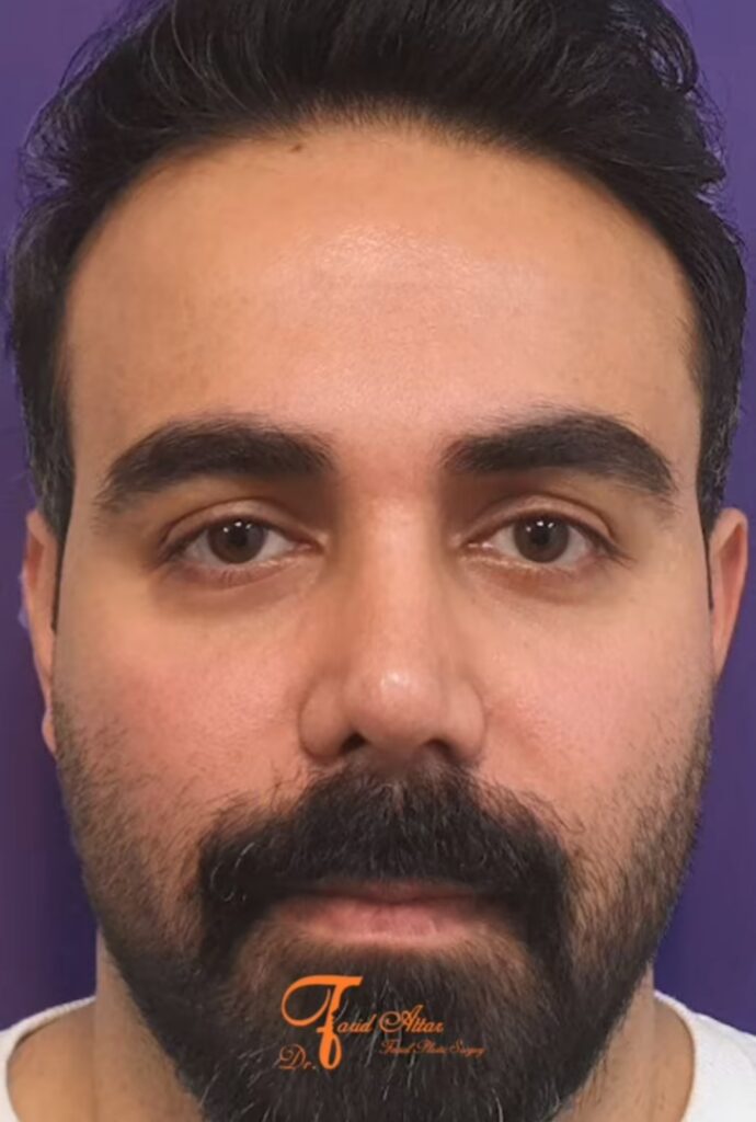 جراحی بینی دکتر فرید عطار؛ بهترین جراح بینی در کرج