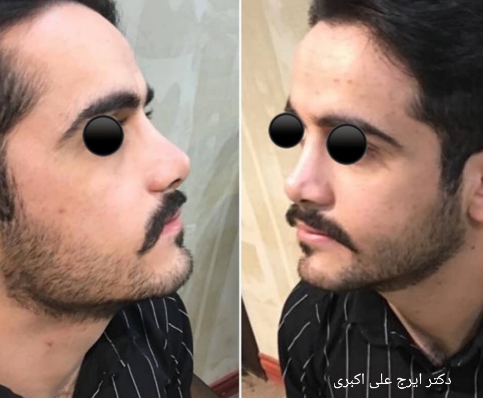 نمونه عمل بینی دکتر ایرج علی اکبری؛ بهترین جراح بینی در کرج