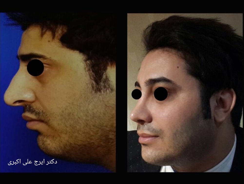 جراحی بینی دکتر ایرج علی اکبری؛ بهترین جراح بینی در کرج