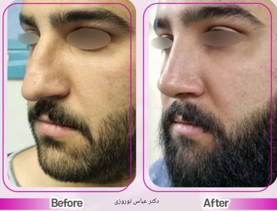 جراحی زیبایی بینی با دکتر عباس نوروزی؛ بهترین جراح بینی در کرج