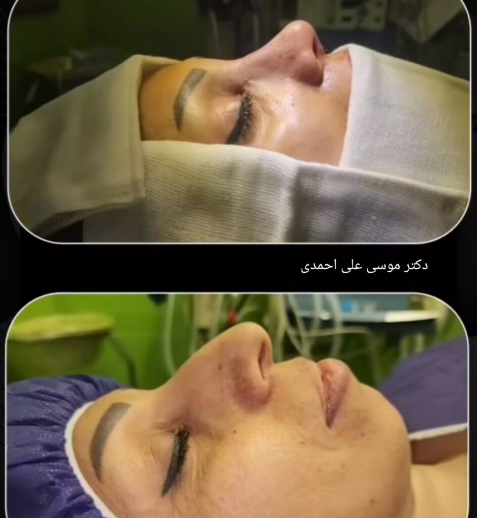 جراحی زیبایی بینی با دکتر موسی علی احمدی؛ بهترین جراح بینی در کرج