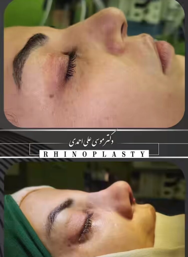 عمل بینی با دکتر موسی علی احمدی؛ بهترین جراح بینی در کرج