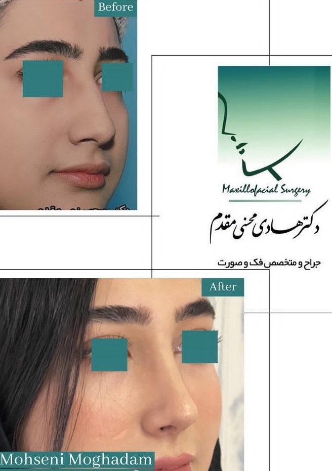 عمل زیبایی بینی با دکتر هادی محسنی مقدم؛ بهترین جراح بینی در کرج