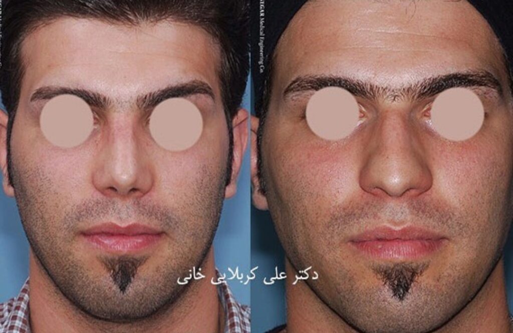 نمونۀ جراحی بینی دکتر علی کربلایی خانی؛ بهترین جراح بینی در کرج