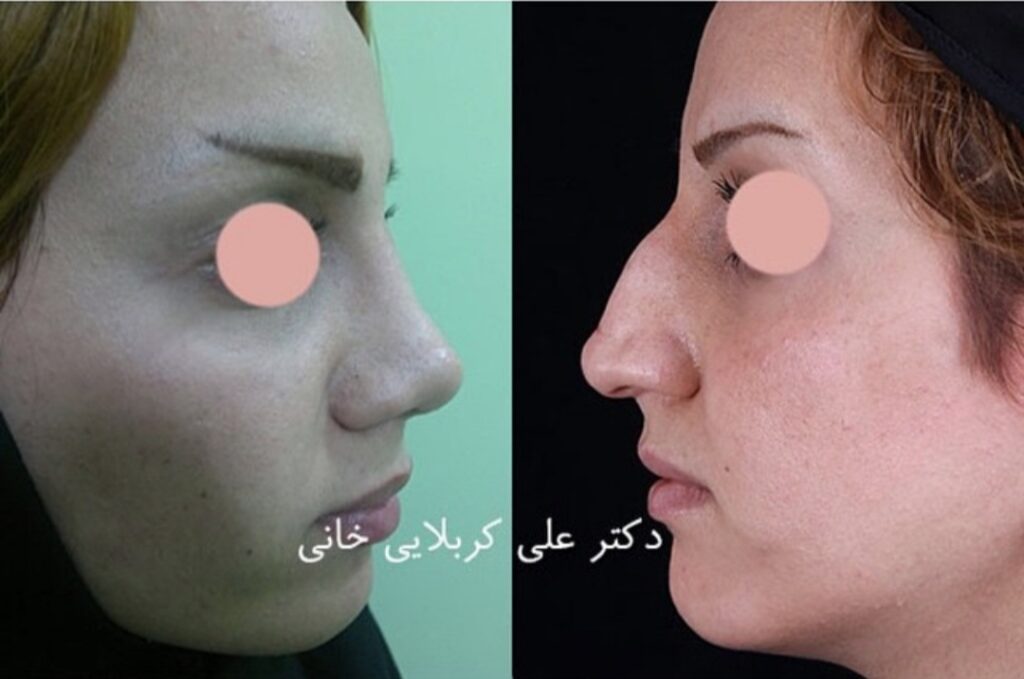 عمل زیبایی بینی دکتر علی کربلایی خانی؛ بهترین جراح بینی در کرج