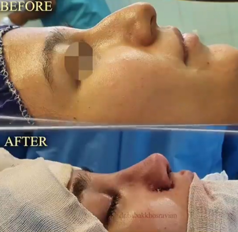 عکس قبل و بعد بینی استخوانی دکتر خسرویان؛ بهترین جراح بینی استخوانی در تهران