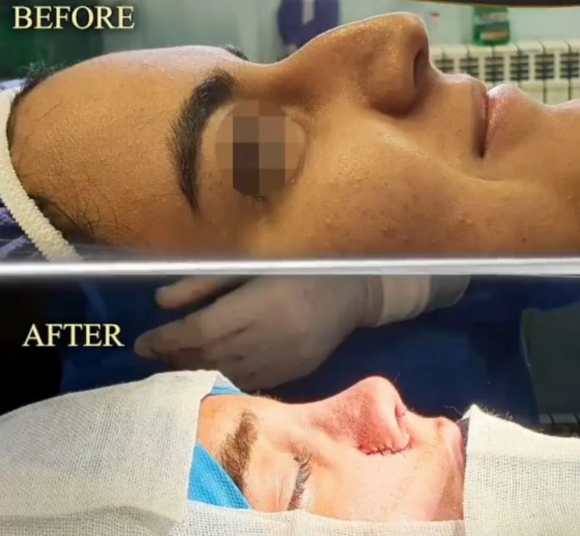 نمونه عمل بینی با دکتر خسرویان؛ بهترین جراح بینی استخوانی در تهران