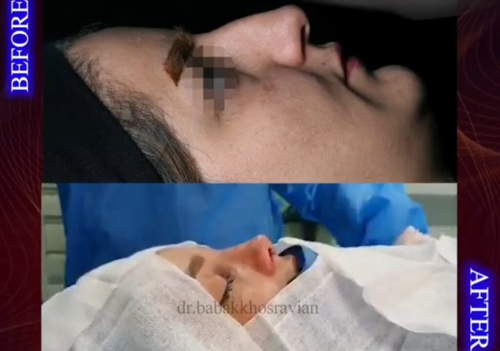 عکس قبل و بعد بینی غضروفی با دکتر بابک خسرویان؛ بهترین جراح بینی استخوانی در تهران