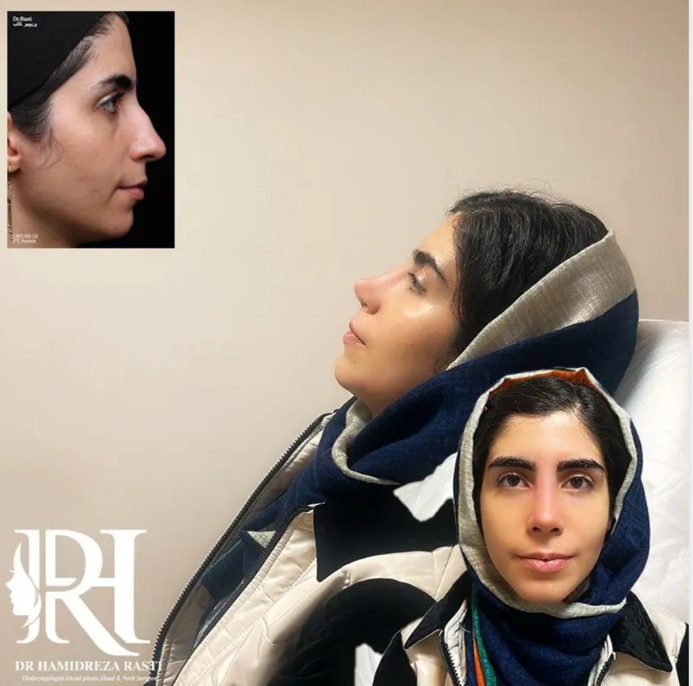 جراحی زیبایی بینی با دکتر حمیدرضا راستی؛ بهترین جراح بینی نیمه فانتزی در تهران