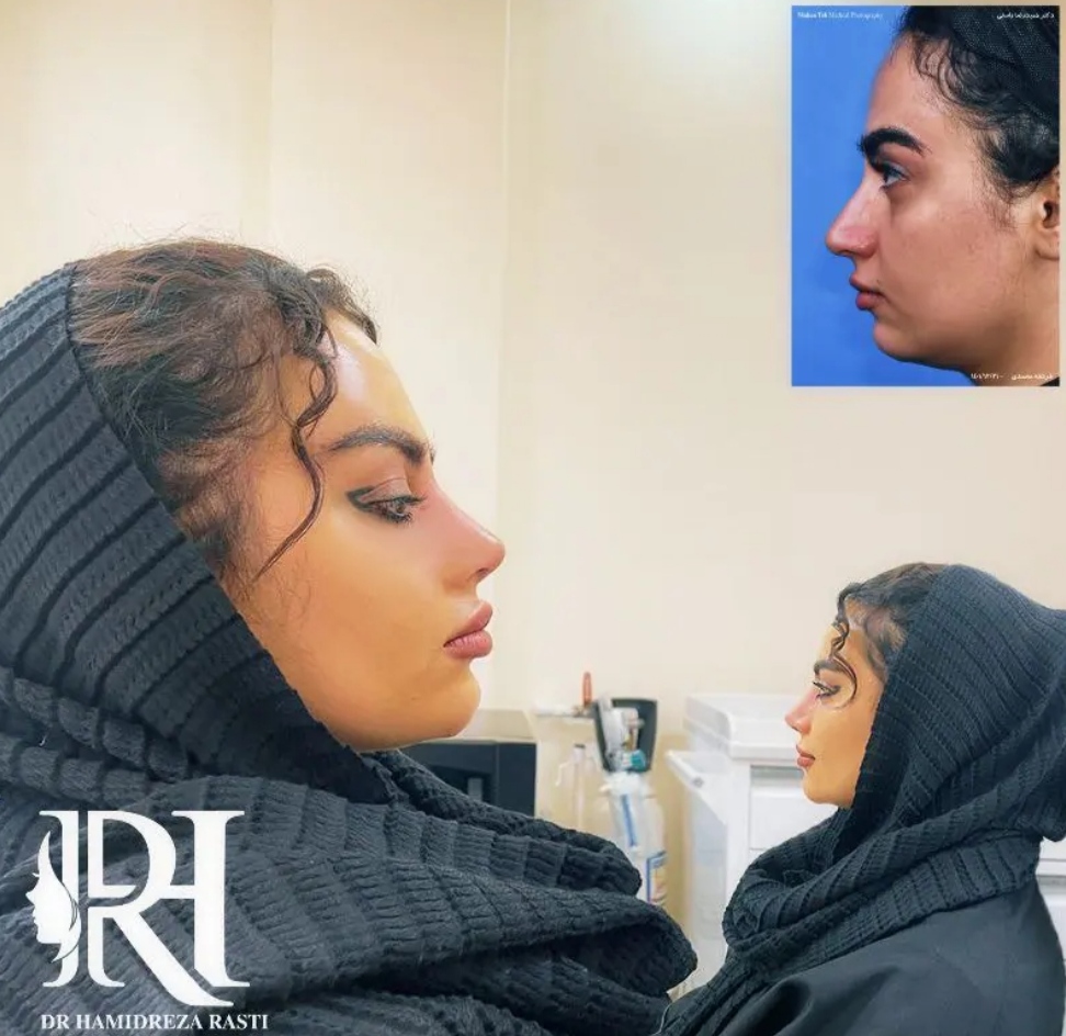 عمل زیبایی بینی دکتر حمیدرضا راستی؛ بهترین جراح بینی استخوانی در تهران