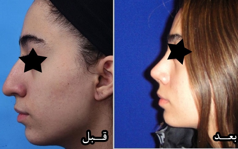 عمل زیبایی بینی با دکتر محمد صوفی زاده؛ بهترین جراح بینی استخوانی در تهران