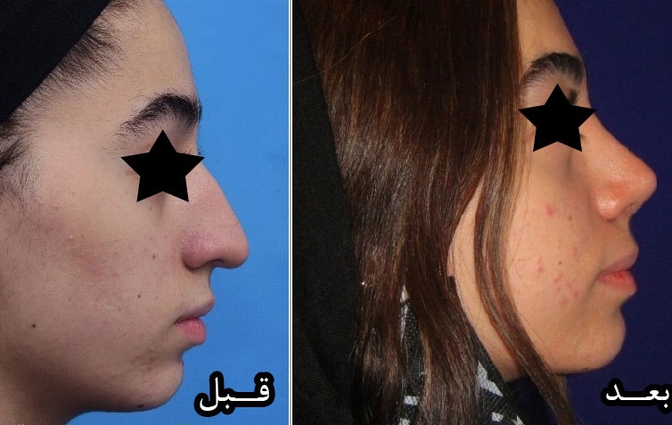 جراحی بینی دکتر محمد صوفی زاده؛ بهترین جراح بینی استخوانی در تهران
