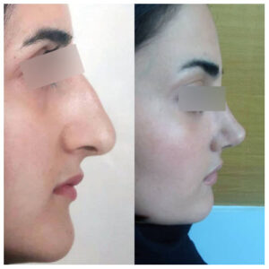 نمونه کار عمل بینی با دکتر یوسف شفائی جراح بینی در تهران