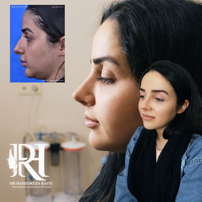 نمونه کار دکتر حمیدرضا راستی جراح بینی گوشتی در تهران