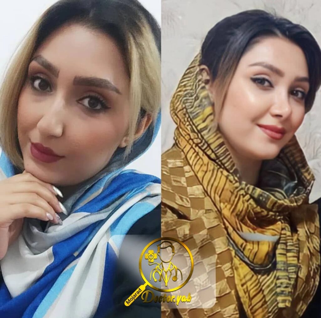 نمونه عمل بینی فانتزی دکتر امید زرگرانی در شیراز