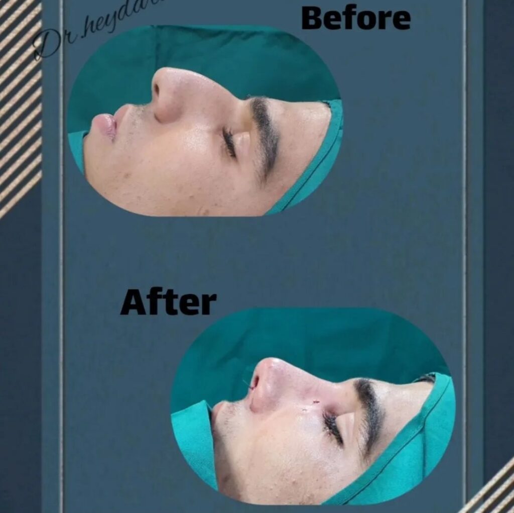 نمونه جراحی بینی دکتر سمیه حیدری در قم