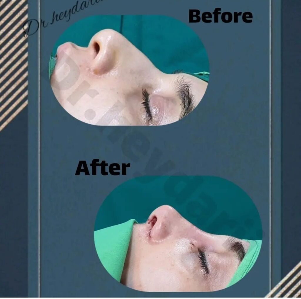 نمونه کار دکتر سمیه حیدری جراح بینی در قم