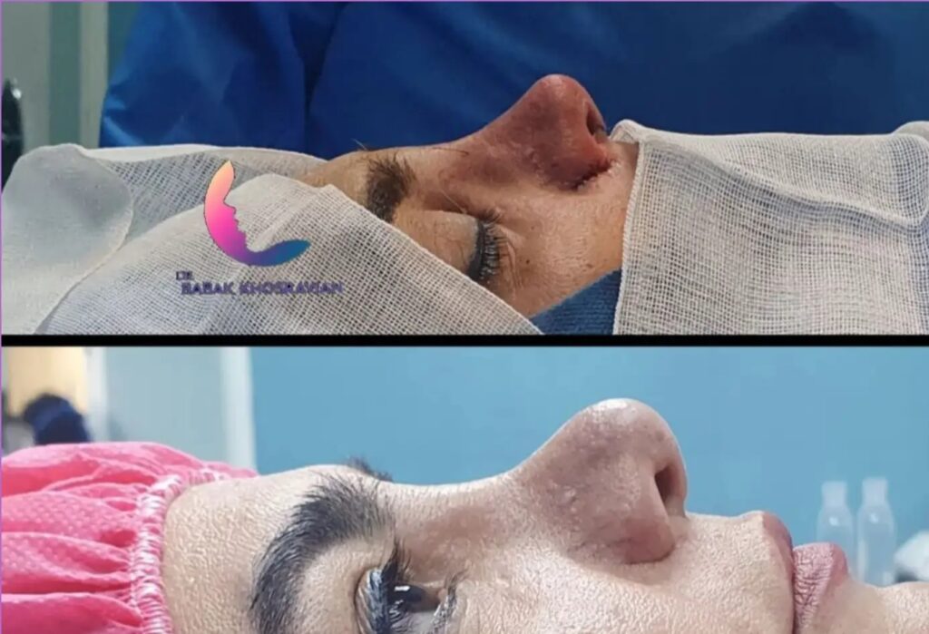 نمونه عمل بینی دکتر بابک خسرویان جراح بینی گوشتی در تهران