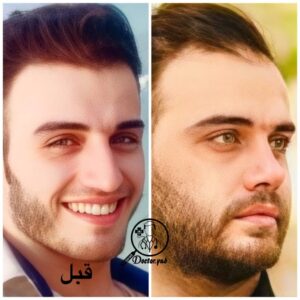 نمونۀ کار جراحی بینی با دکی یاب؛ بهترین جراح بینی در کرج