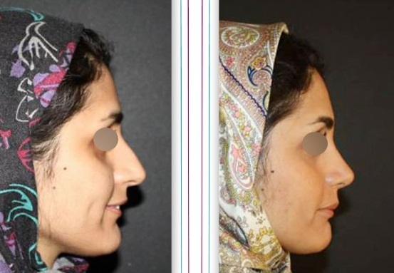 نمونه جراحی بینی دکتر نادره آلانی در قم