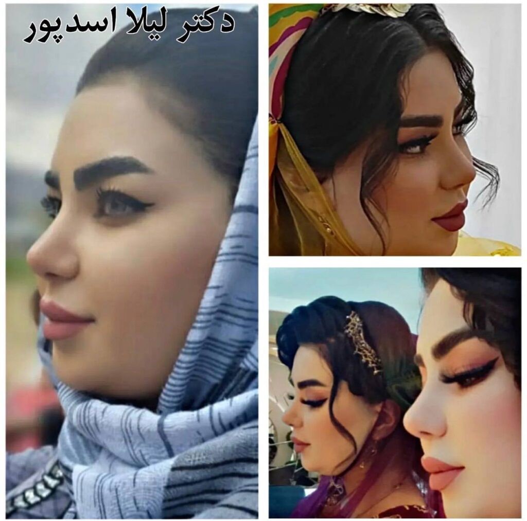 نمونه عمل بینی استخوانی دکتر لیلا اسدپور در شیراز