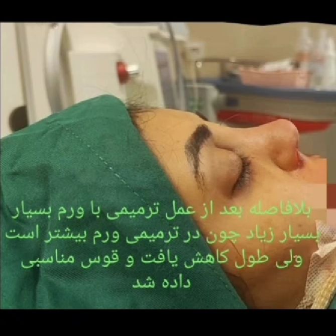 نمونه کار عمل بینی دکتر سید حمزه هاشمی؛ بهترین جراح بینی در یاسوج
