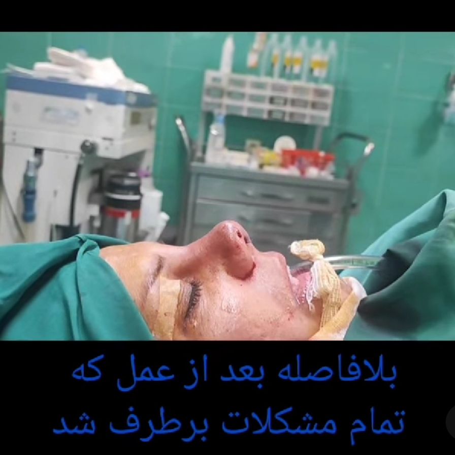 نمونه جراحی بینی دکتر سید حمزه هاشمی؛ بهترین جراح بینی در یاسوج