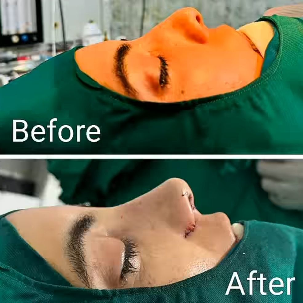 نمونه کار عمل بینی دکتر شهاب اسدی محمود آبادی؛ بهترین جراح بینی در یاسوج