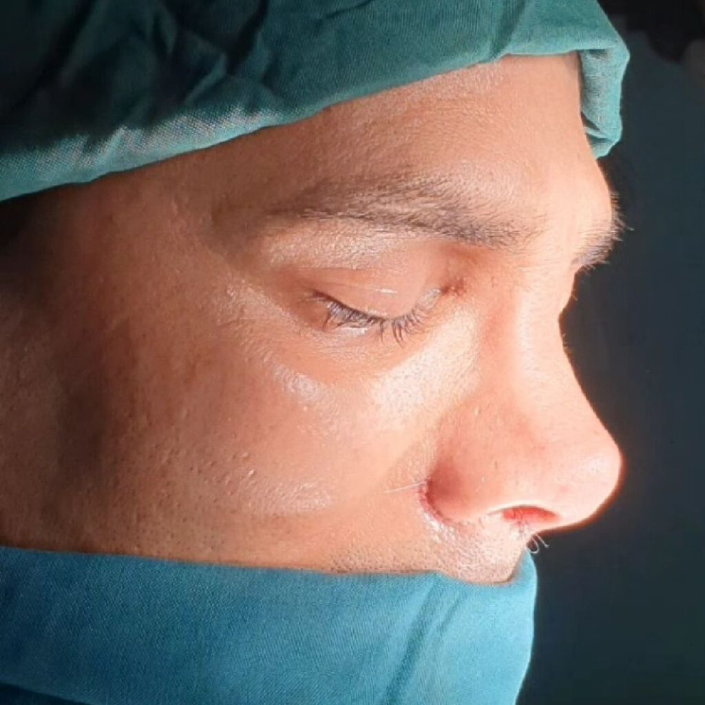 نمونه کار عمل بینی دکتر مصطفی محمدی؛ بهترین جراح بینی در یاسوج