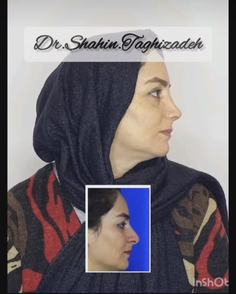 نمونه کار دکتر شاهین تقی زاده جراح بینی در کردستان