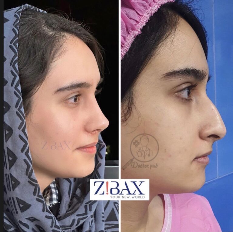 نمونه جراحی بینی با مشاوره دکی یاب؛ هزینه عمل بینی استخوانی در شیراز