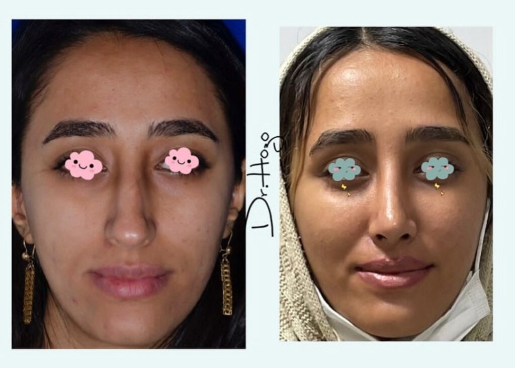نمونه عمل دکتر حسنا زبیری جراح بینی در کردستان
