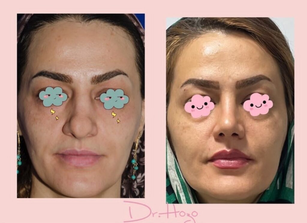 نمونه کار دکتر حسنا زبیری جراح بینی در کردستان