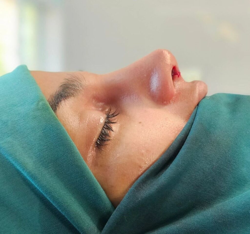 نمونه کار دکتر کمال فرجی جراح بینی در کردستان