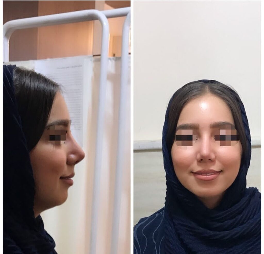 نمونه عمل بینی دکتر آذر فیضی جراح بینی در کردستان