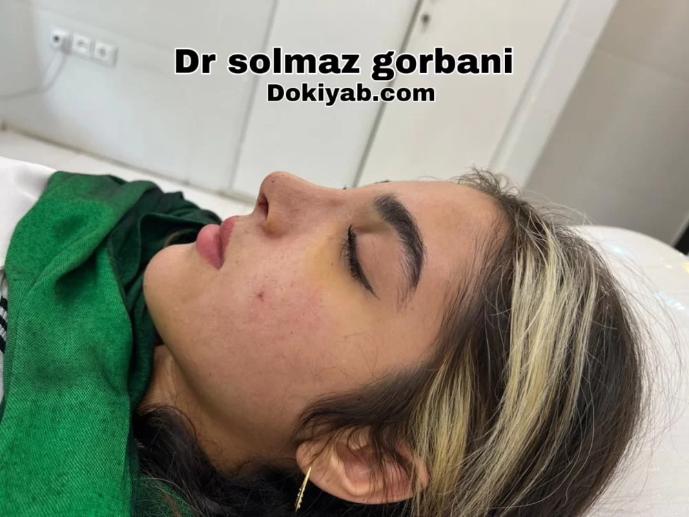 نمونه کار دکتر سولماز قربانی جراح بینی استخوانی در شیراز