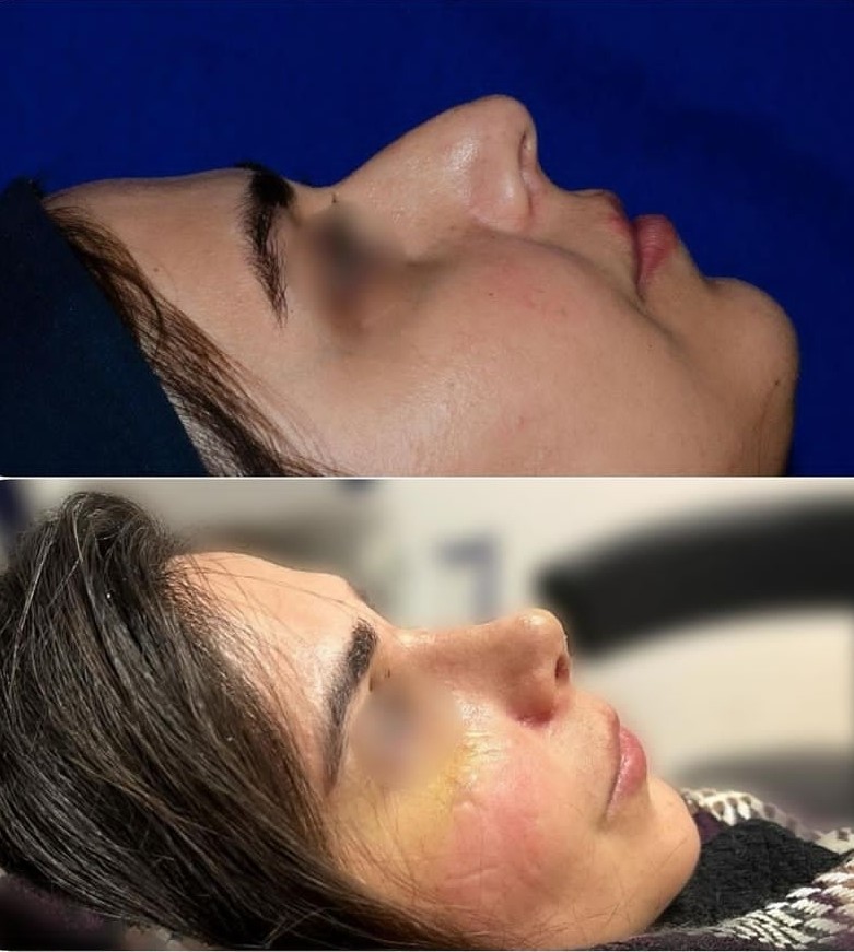 نمونه عمل بینی دکتر بهمن قمری جراح بینی در کردستان
