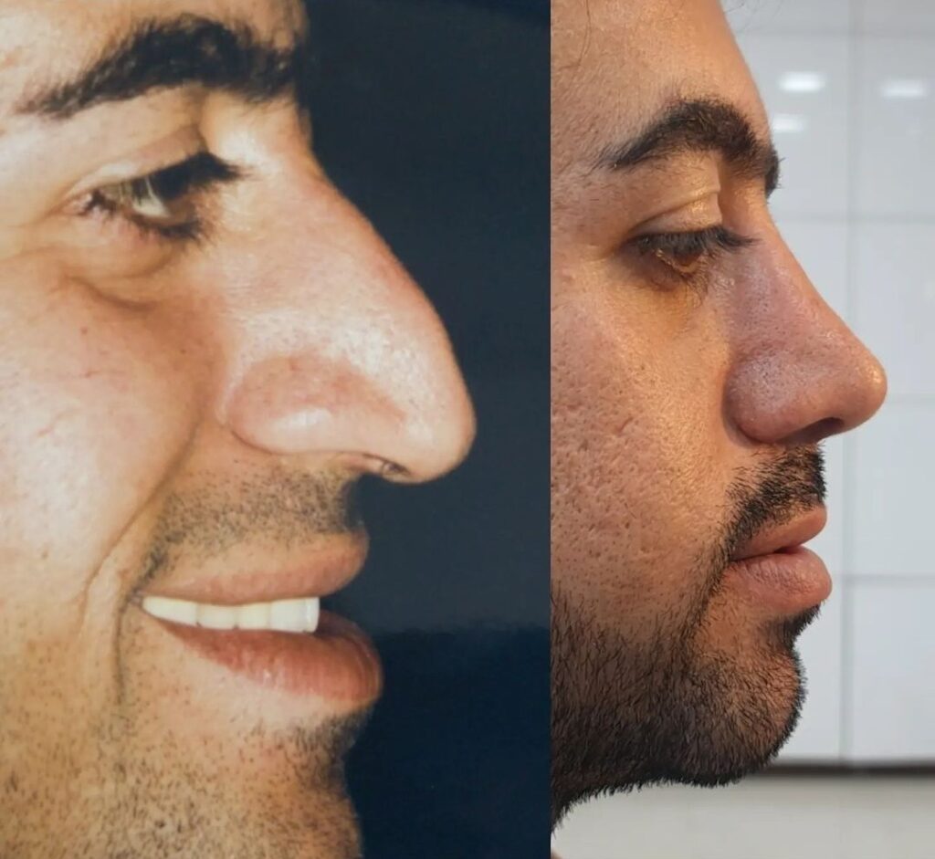 نمونه جراحی بینی دکتر نعمت الله میرزایی در کردستان