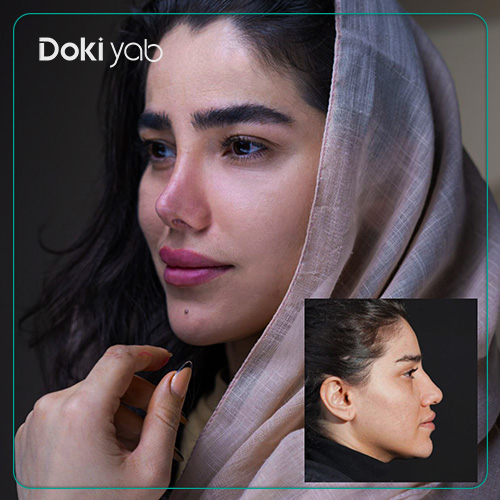 عوارض جراحی بینی استخوانی در تهران