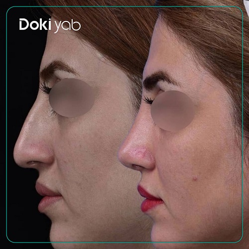 جراحی زیبایی بینی دکتر روزینا بشارتی زاده؛ بهترین جراح بینی استخوانی تهران