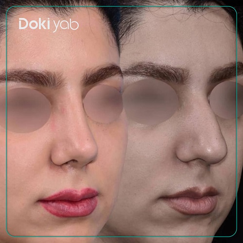 نمونه عمل بینی دکتر روزینا بشارتی زاده؛ بهترین جراح بینی استخوانی تهران
