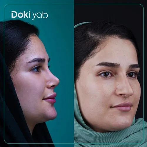 نمونه کار بهترین دکتر عمل بینی استخوانی در تهران؛ مجموعه دکی یاب