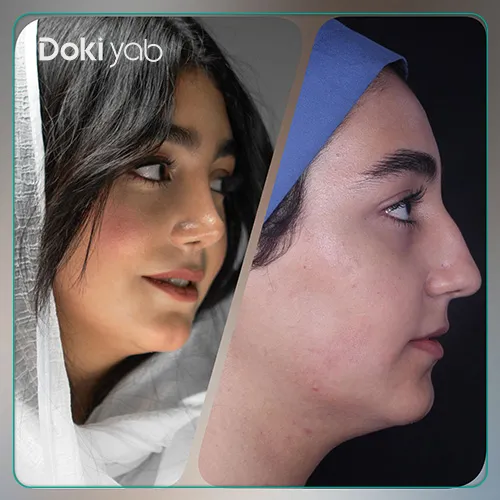 نتیجه عالی از انتخاب بهترین دکتر عمل بینی استخوانی در تهران با مشاوره مجموعه دکی یاب
