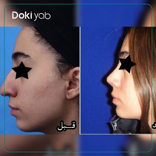 جراحی بینی دکتر محمد صوفی زاده؛ بهترین جراح بینی استخوانی در تهران
