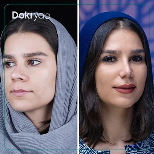بهترین دکتر بینی گوشتی در تهران؛ نتیجه جراحی زیباجوی مجموعه دکی‌ یاب