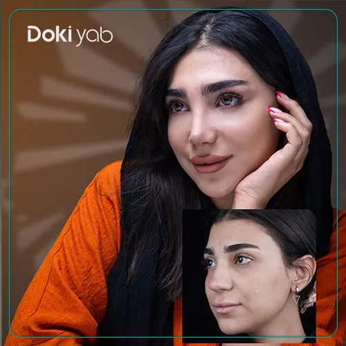 عکس قبل و بعد از عمل بینی توسط بهترین جراح بینی گوشتی در تهران؛ مجموعه دکی‌ یاب