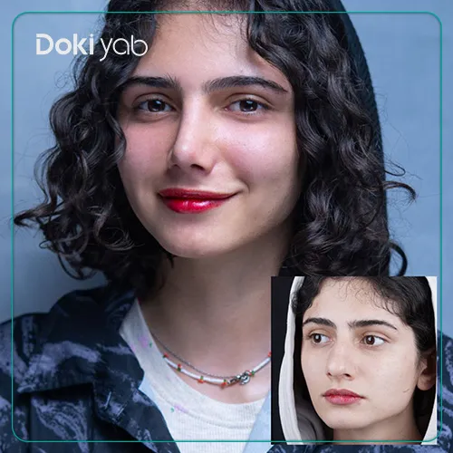 نمونه عمل بینی گوشتی توسط بهترین دکتر بینی گوشتی تهران با پشتیبانی دکی‌ یاب